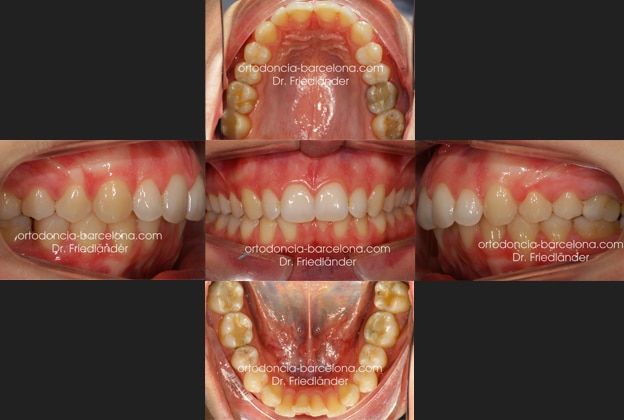 ortodoncia friedländer Barcelona Invisalign incognito lingual invisible estetica transparente (1) ortodoncia friedländer Barcelona Invisalign incognito lingual invisible estetica transparente (1)