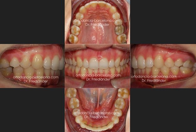 ortodoncia friedländer Barcelona Invisalign incognito lingual invisible estetica transparente (2) ortodoncia friedländer Barcelona Invisalign incognito lingual invisible estetica transparente (2)
