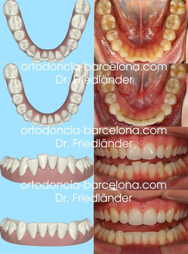 ortodoncia friedländer Barcelona Invisalign incognito lingual invisible estetica transparente (3) ortodoncia friedländer Barcelona Invisalign incognito lingual invisible estetica transparente (3)