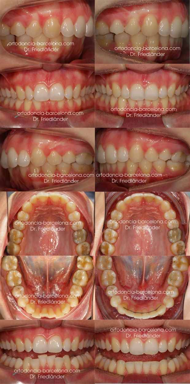 ortodoncia friedländer Barcelona Invisalign incognito lingual invisible estetica transparente (4) ortodoncia friedländer Barcelona Invisalign incognito lingual invisible estetica transparente (5)