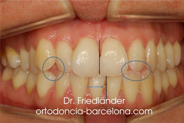 invisalign ortodoncia friedlander barcelona invisible transparente lingual estetica (1) invisalign ortodoncia friedlander barcelona invisible transparente lingual estetica