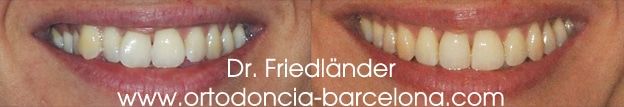 invisalign ortodoncia friedlander barcelona invisible transparente lingual estetica (2) invisalign ortodoncia friedlander barcelona invisible transparente lingual estetica (2)
