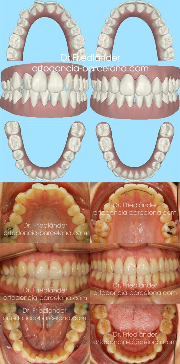 invisalign ortodoncia friedlander barcelona invisible transparente lingual estetica (3) invisalign ortodoncia friedlander barcelona invisible transparente lingual estetica (3)