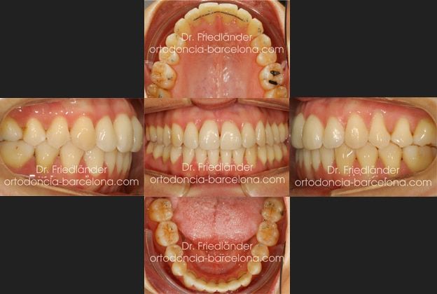 invisalign ortodoncia friedlander barcelona invisible transparente lingual estetica (4) invisalign ortodoncia friedlander barcelona invisible transparente lingual estetica (4)
