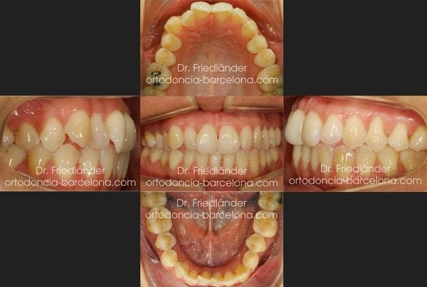 invisalign ortodoncia friedlander barcelona invisible transparente lingual estetica (5) invisalign ortodoncia friedlander barcelona invisible transparente lingual estetica