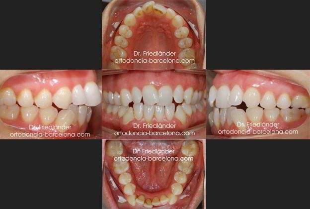 Ortodoncia Friedländer Barcelona invisalign invisible lingual transparente estetica