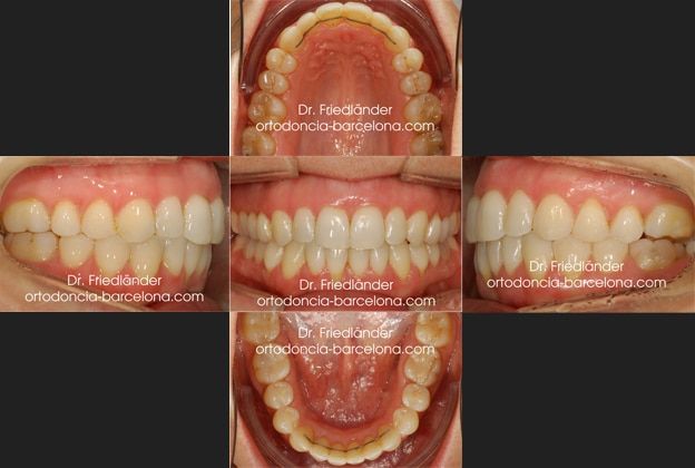 Ortodoncia Friedländer Barcelona invisalign invisible lingual transparente estetica