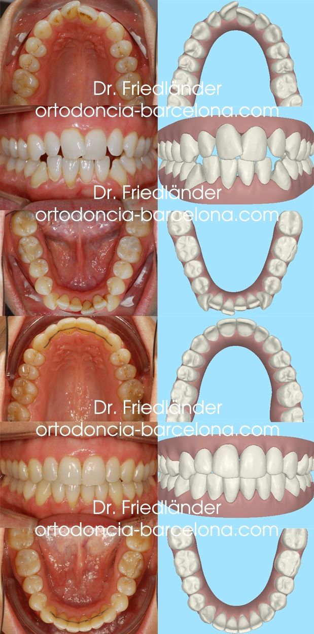 Ortodoncia Friedländer Barcelona invisalign invisible lingual transparente estetica (3)
