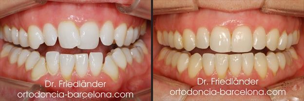 Ortodoncia Friedländer Barcelona invisalign invisible lingual transparente estetica (3)