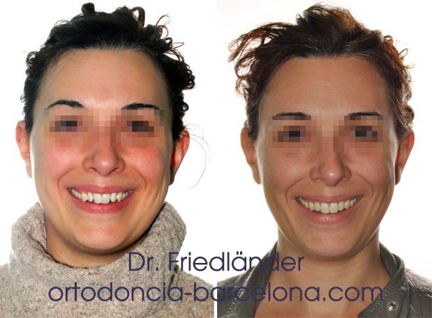 Ortodoncia Friedländer Barcelona invisalign invisible lingual transparente estetica (3)
