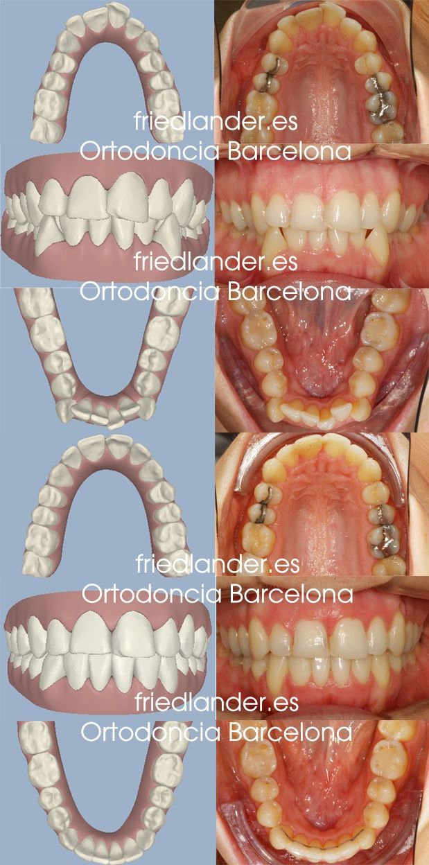 Ortodoncia Friedländer Barcelona Invisalign incognito lingual invisible estetica autoligado transparente