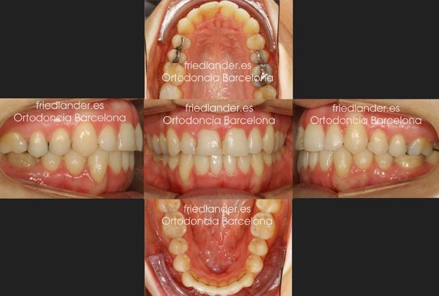Ortodoncia Friedländer Barcelona Invisalign incognito lingual invisible estetica autoligado transparente