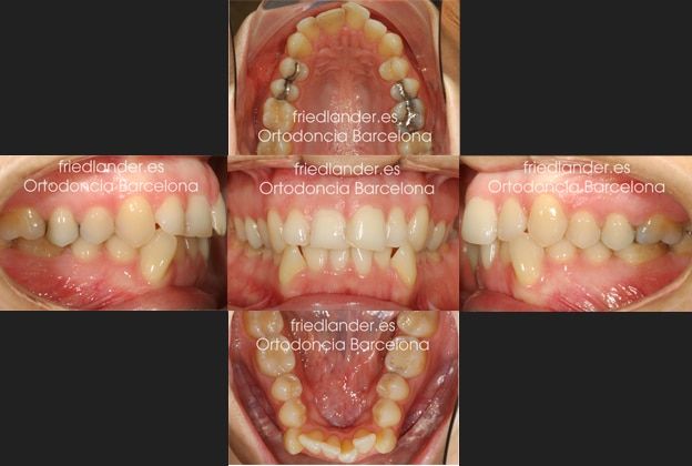 Ortodoncia Friedländer Barcelona Invisalign incognito lingual invisible estetica autoligado transparente