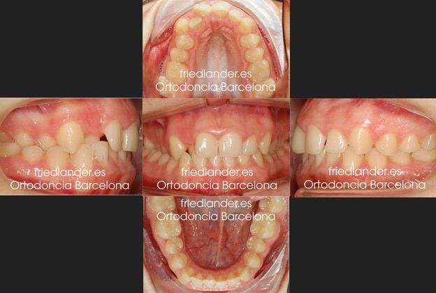 Friedländer Ortodoncia Barcelona Invisalign Invisible lingual incognito estetica autoligado (1)