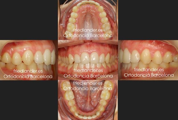 Friedländer Ortodoncia Barcelona Invisalign Invisible lingual incognito estetica autoligado (1)