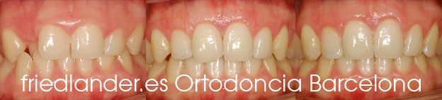 Friedländer Ortodoncia Barcelona Invisalign Invisible lingual incognito estetica autoligado (1)