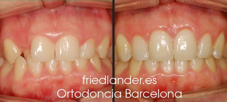 Friedländer Ortodoncia Barcelona Invisalign Invisible lingual incognito estetica autoligado