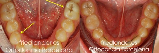 Ortodoncia Friedlander Barcelona invisalign transparente lingual invisible autoligado estetica (2)