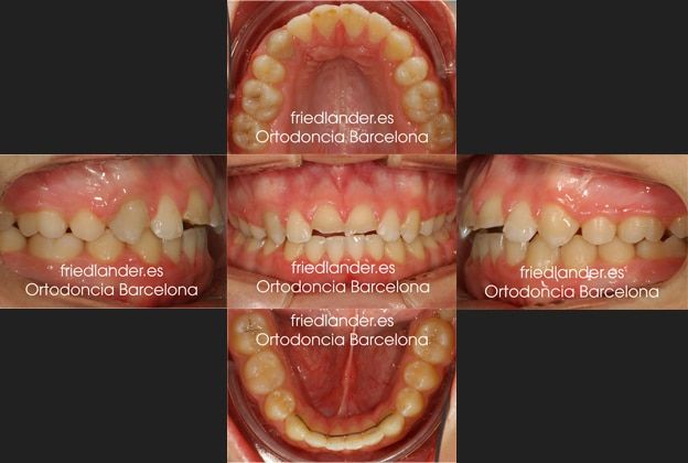 Ortodoncia Friedlander Barcelona invisalign transparente lingual invisible autoligado estetica (2)