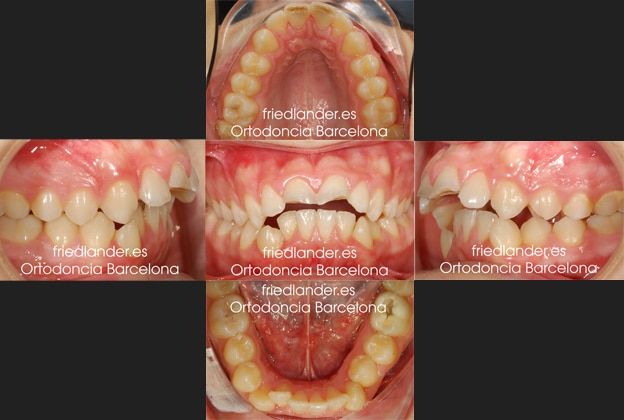 Ortodoncia Friedlander Barcelona invisalign transparente lingual invisible autoligado estetica (4)