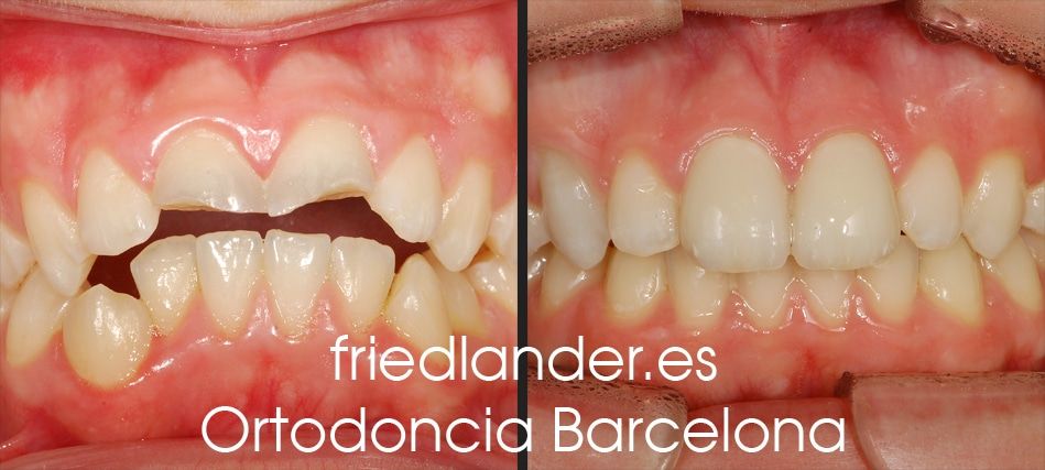Ortodoncia Friedlander Barcelona invisalign transparente lingual invisible autoligado estetica