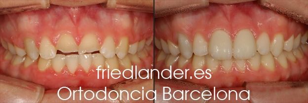 Ortodoncia Friedlander Barcelona invisalign transparente lingual invisible autoligado estetica (6)