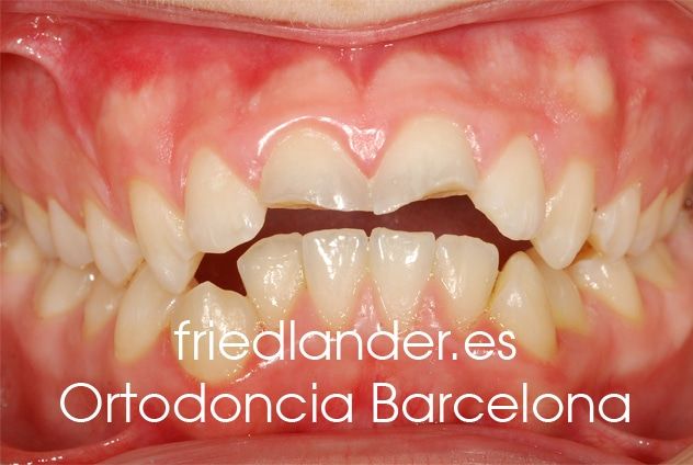 Ortodoncia Friedlander Barcelona invisalign transparente lingual invisible autoligado estetica (f) Ortodoncia Friedlander Barcelona invisalign transparente lingual invisible autoligado estetica (f)