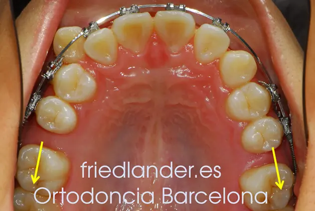 Ortodoncia Friedlander Barcelona lingual invisible Invisalign transparente incognito win estetica autoligado