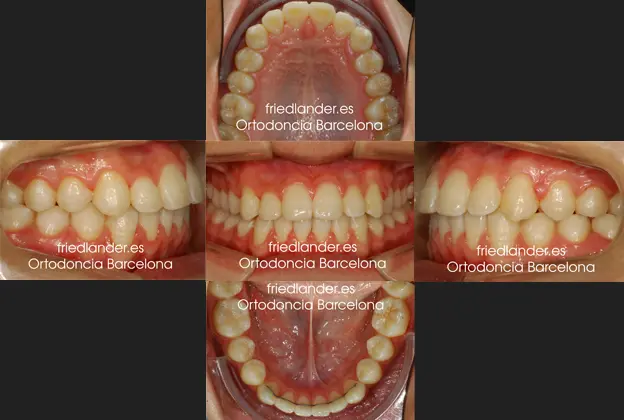 Ortodoncia Friedlander Barcelona lingual invisible Invisalign transparente incognito win estetica autoligado (3)