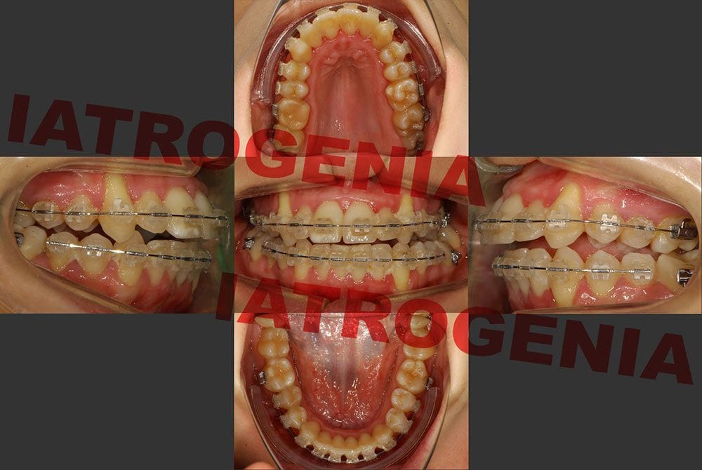 iatrogenia La paciente presenta recesiones gingivales severas, clase II, mordida abierta y cruzada, y no puede cerrar la boca correctamente.
