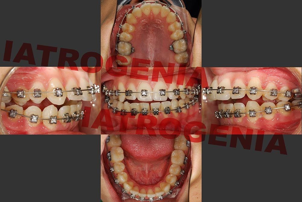 iatrogenia-2 iatrogenia o mala praxis en ortodoncia