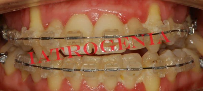 La ortodoncia lingual, la mejor forma de enderezar tus dientes sin que nadie se entere • Avodent