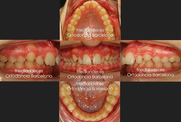 Ortodoncia Friedlander Barcelona Lingual Invisible Invisalign Transparente Estetica autoligado orto