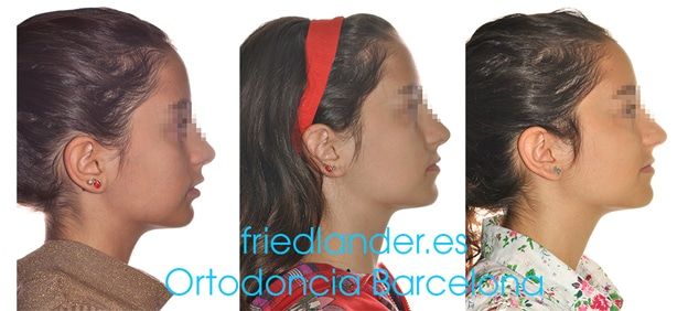 Ortodoncia Friedlander Barcelona Lingual Invisible Invisalign Transparente Estetica autoligado