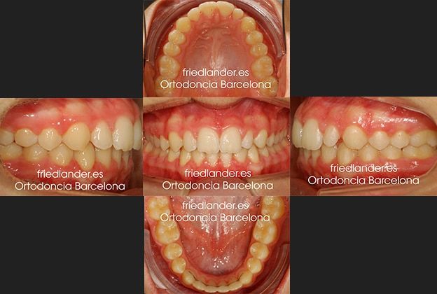 Ortodoncia Friedlander Barcelona Lingual Invisible Invisalign Transparente Estetica autoligado