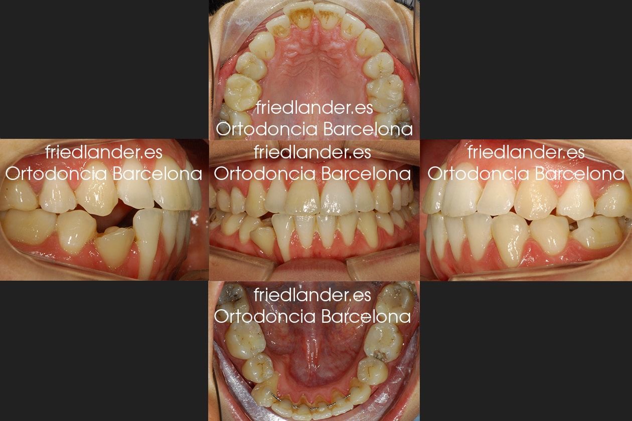Ortodoncia Friedlander Barcelona Lingual invisible win incognito Invisalign transparente brackets estetica