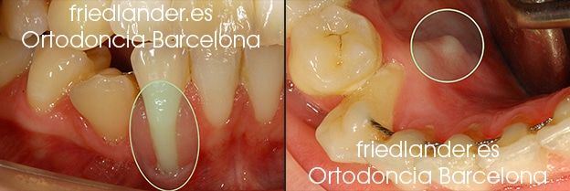 Ortodoncia Friedlander Barcelona Lingual invisible win incognito Invisalign transparente brackets estetica