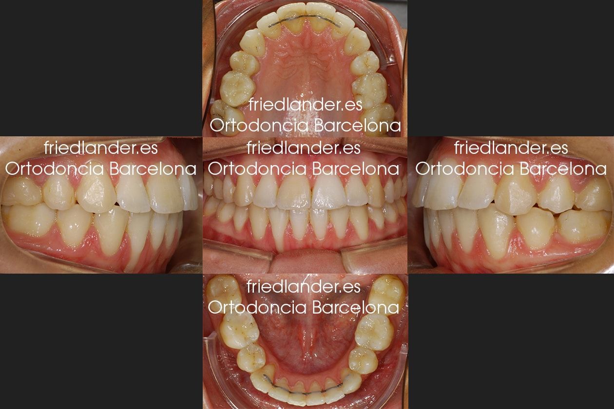 Ortodoncia Friedlander Barcelona Lingual invisible win incognito Invisalign transparente brackets despues Ortodoncia Friedlander Barcelona Lingual invisible win incognito Invisalign transparente brackets despues