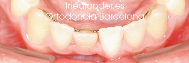 Ortodoncia Friedlander Barcelona Lingual invisible win incognito Invisalign transparente