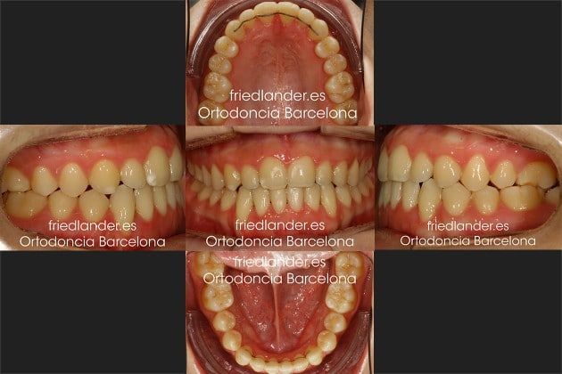 Ortodoncia Friedlander Barcelona Invisalign invisible lingual caninos incluidos estetica