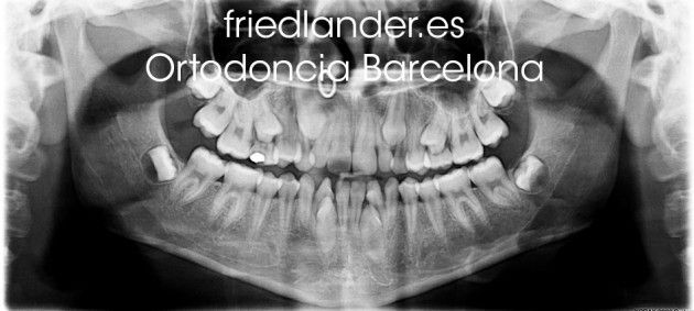 Ortodoncia Friedlander Barcelona Invisalign invisible lingual caninos incluidos 2