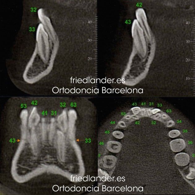Ortodoncia Friedlander Barcelona Invisalign invisible lingual caninos incluidos estetica