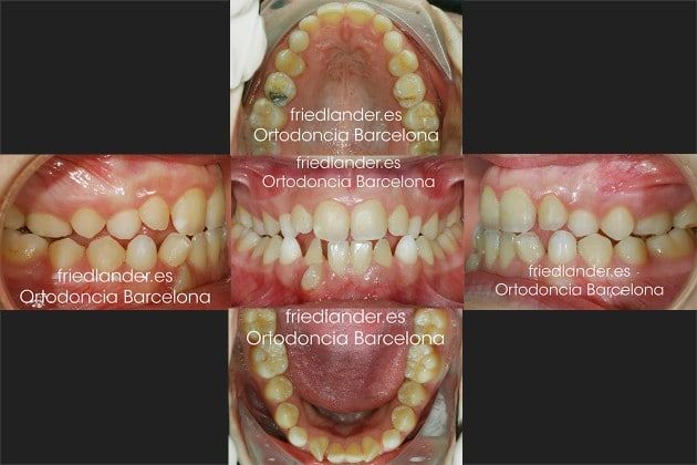 Ortodoncia Friedlander Barcelona Invisalign invisible lingual caninos incluidos estetica