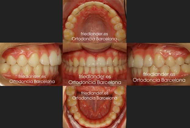 Ortodoncia Friedlander Barcelona Invisalign lingual invisible autoligado