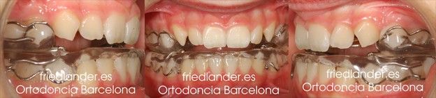 tratameinto de Ortodoncia Friedlander Barcelona Invisalign lingual invisible autoligado clase II
