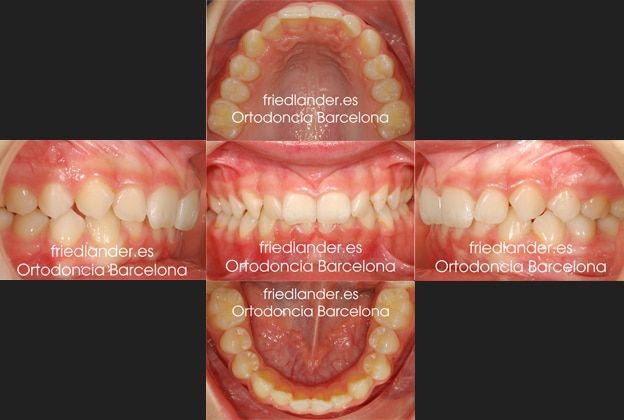 Ortodoncia Friedlander Barcelona Invisalign lingual invisible autoligado clase II