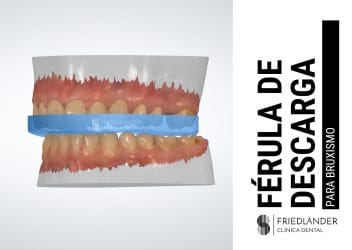 ferula de descarga bruxismo
