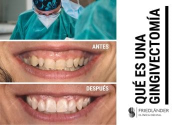 gingivectomia