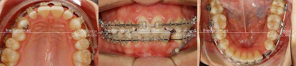 ortodoncia friedlander barcelona brackets esteticos canino inferior invisalign