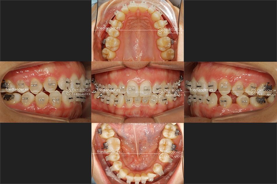 ortodoncia friedlander barcelona brackets esteticos canino inferior lingual